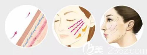 趙醫(yī)生做埋線提升的手術(shù)步驟示意圖 趙醫(yī)生做埋線提升的手術(shù)步驟示意圖