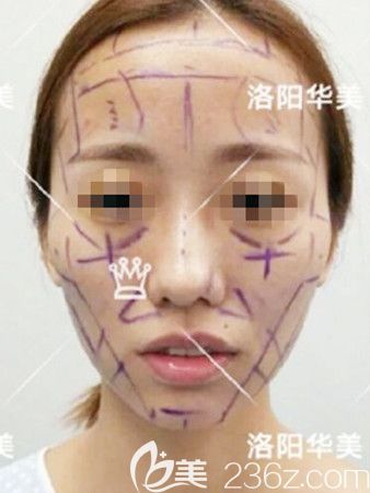 脂肪填充術(shù)前 脂肪填充術(shù)前