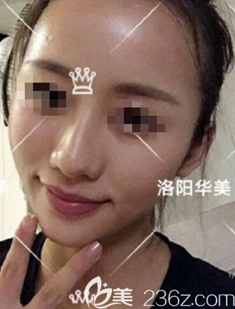 脂肪填充5天恢復(fù)效果 脂肪填充5天恢復(fù)效果