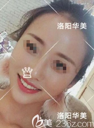 脂肪填充一個月恢復(fù)效果 脂肪填充一個月恢復(fù)效果