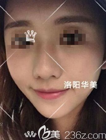 怕自體脂肪填充全臉很假的快速看這篇恢復(fù)很自然的圖片對比效果來避坑