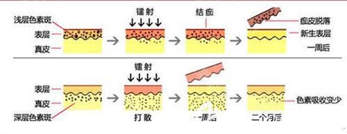 孫醫(yī)生采用激光祛斑手術(shù)簡易圖
