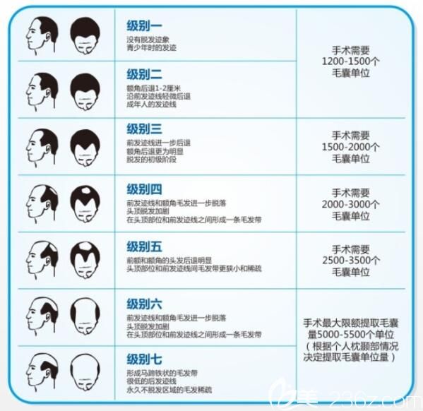 男士脫發(fā)等級示意圖 男士脫發(fā)等級示意圖