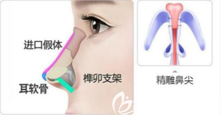 埃菲爾隆鼻技術(shù)優(yōu)勢(shì) 埃菲爾隆鼻技術(shù)優(yōu)勢(shì)