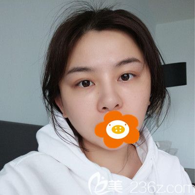 20200303_1583224733706680.jpg 術(shù)后5天_副本.jpg