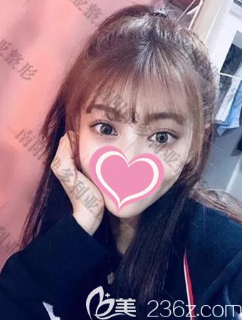 雙眼皮手術(shù)后30天的恢復(fù)照片