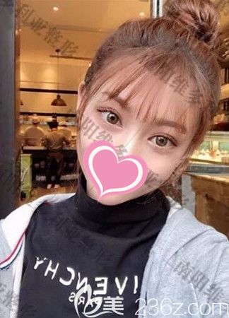 糾結(jié)雙眼皮做哪個(gè)好后選了全切8mm手術(shù)恢復(fù)后效果你來評(píng)價(jià)