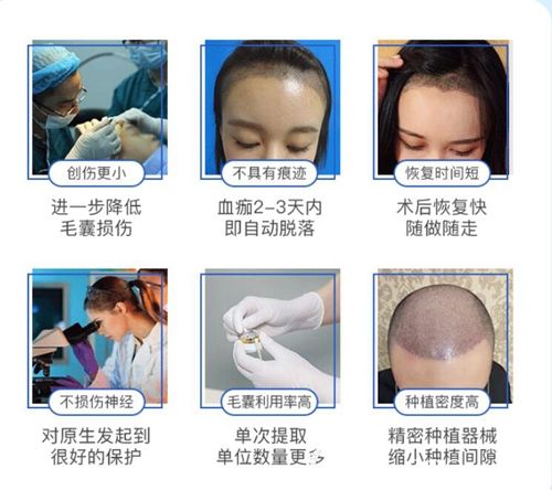 毛發(fā)移植手術(shù)的過程步驟