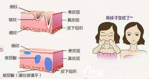 黃彩龍醫(yī)生注射玻尿酸除皺過程 黃彩龍醫(yī)生注射玻尿酸除皺過程