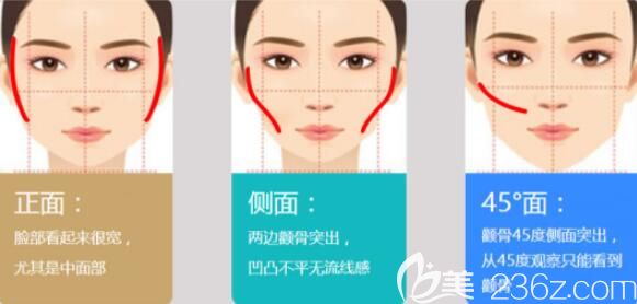 顴骨手術(shù)的適應(yīng)情況