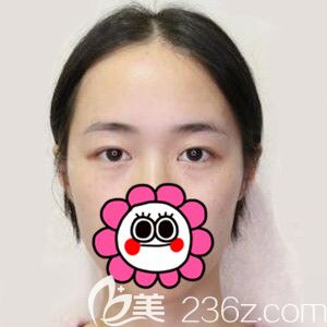 做定點雙眼皮開眼角術(shù)前照 做定點雙眼皮開眼角術(shù)前照