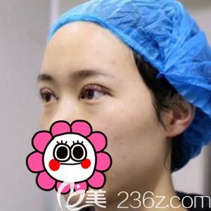 做完定點雙眼皮術(shù)后即刻<span style= 做完定點雙眼皮術(shù)后即刻<span style=