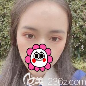 做定點雙眼皮開眼角術(shù)后半個月恢復(fù)<span style= 做定點雙眼皮開眼角術(shù)后半個月恢復(fù)<span style=