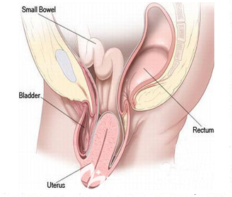 子宮下垂矯正手術(shù)