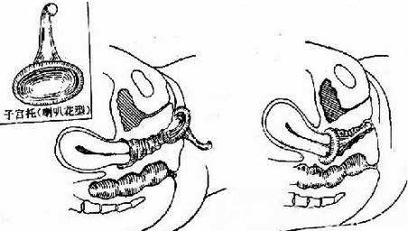 為什么生完孩子的女人更容易發(fā)生漏尿現(xiàn)象呢？
