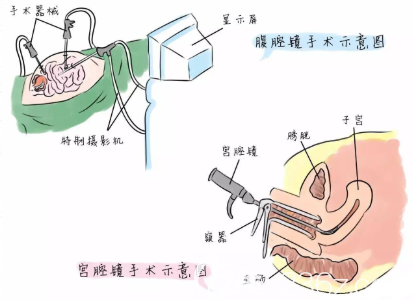通過子宮下垂矯正能夠改善漏尿現(xiàn)象嗎？