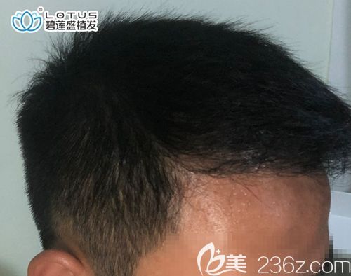 做頭頂加密植發(fā)三個月沒看到效果，我還以為是植發(fā)失敗了......