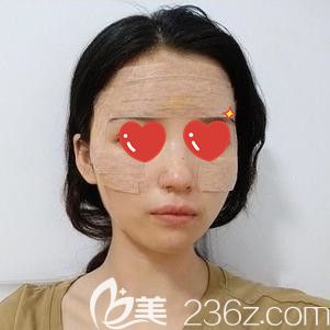 面部脂肪填充后粘的固定膠帶