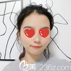 脂肪填充18天面部飽滿