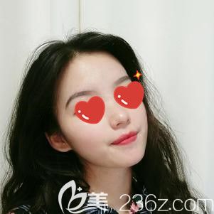 面部填充術(shù)后47天脂肪少數(shù)被吸收