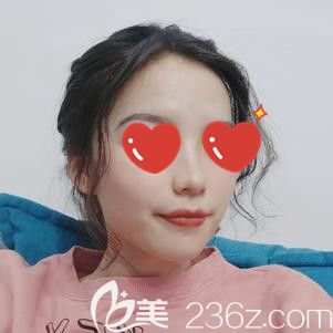 “顴弓外擴(kuò)”不一定要做手術(shù)才能改善，我就只做了自體脂肪面部填充就達(dá)到了想要的效果