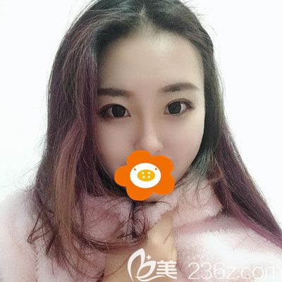 面頰,雙下巴,下頜緣3個(gè)部位一起做面部吸脂，趕走了我的大臉盤(pán)子！