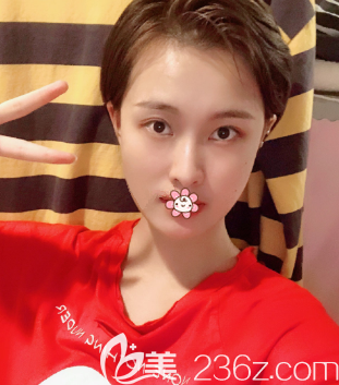 自體脂肪填充術(shù)后一個月 自體脂肪填充術(shù)后一個月