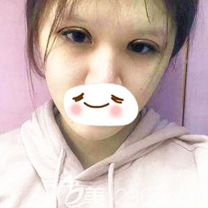 剛做完眼綜合手術(shù)后眼睛腫脹感較強(qiáng)