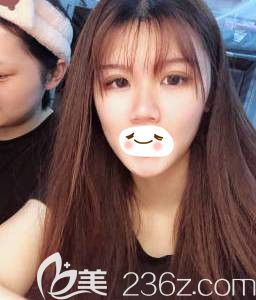 沒做過眼綜合的寶寶可以參考下我做全切雙眼皮+上瞼去脂+開內(nèi)眼角的術(shù)后效果