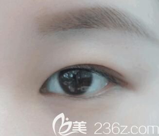 內(nèi)雙的人適不適合割雙眼皮？