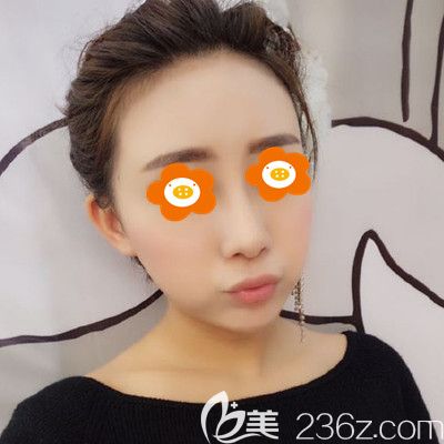 注射2ml愛芙萊玻尿酸豐唇已經(jīng)40天，頭一次填充吸收的挺好！