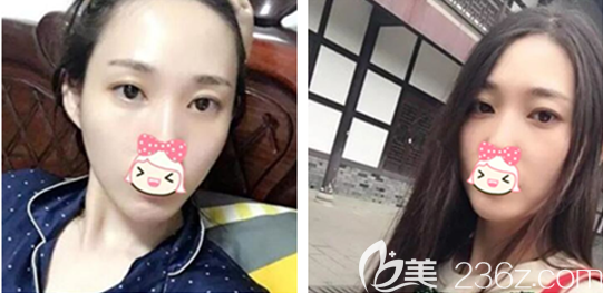 老實說我也驚訝頭一回做內(nèi)切祛眼袋手術沒失敗沒凹陷也看不出疤