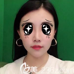 只想做個假體隆鼻為啥醫(yī)生非讓我做個半肋軟骨隆鼻，難道就是為了多掙錢