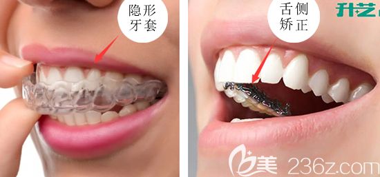 想要矯正過程美觀可選隱形矯正和舌側(cè)矯正