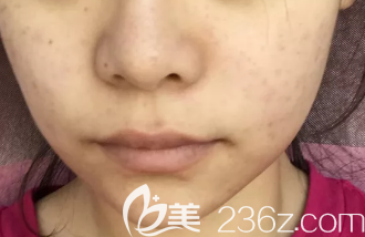 隆鼻術(shù)前照片 隆鼻術(shù)前照片