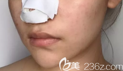 隆鼻術(shù)中照片 隆鼻術(shù)中照片