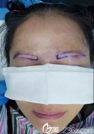 眉毛天生稀疏通過眉毛種植解決困擾 眉毛天生稀疏通過眉毛種植解決困擾