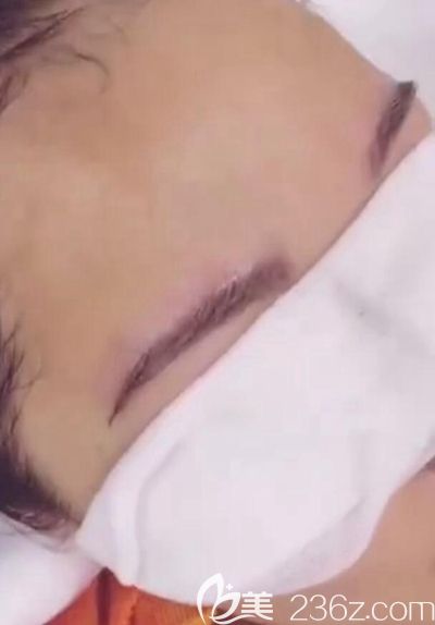 種植眉毛親身經(jīng)歷手術(shù)視頻來嘍!此次一共提取了后腦勺300多個毛囊