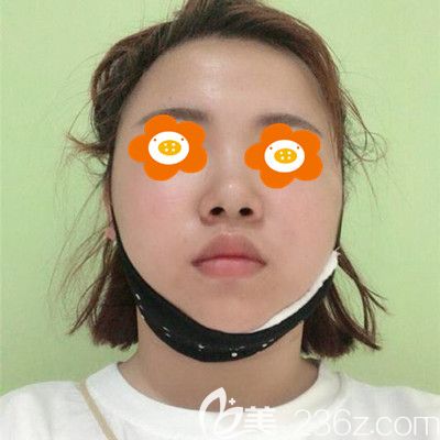 術后第4天還帶著頭套 術后第4天還帶著頭套