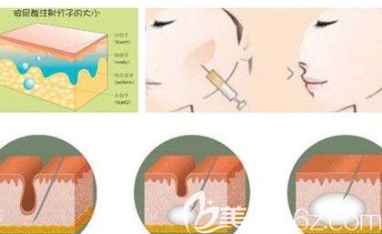 薛華棟醫(yī)生注射玻尿酸塑形