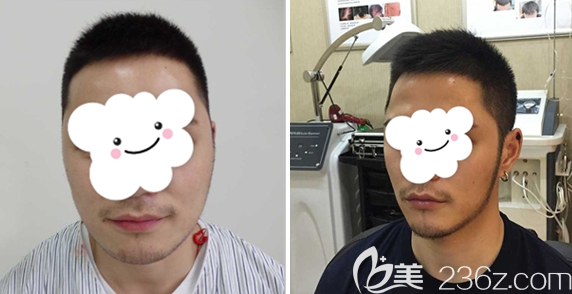 通過(guò)種植鬢角前后對(duì)比圖看得出我的要求達(dá)到了