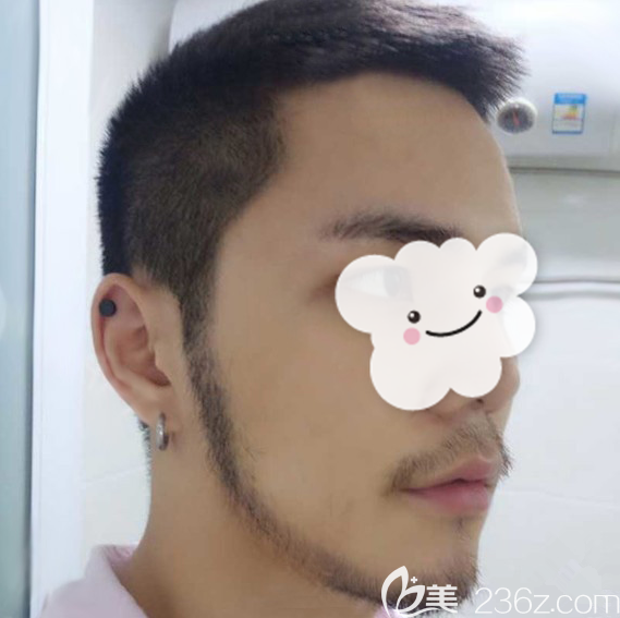 ?我在廈門這家機(jī)構(gòu)做的種植鬢角花了不到一萬五，但是設(shè)計(jì)到位臉看起來特別立體