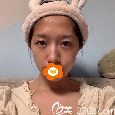 做面部填充手術(shù)前的我 做面部填充手術(shù)前的我