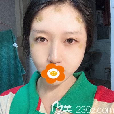 術(shù)后第3天臉上貼著膠布 術(shù)后第3天臉上貼著膠布