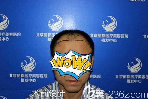 術(shù)前兩額角及頭頂脫發(fā) 術(shù)前兩額角及頭頂脫發(fā)