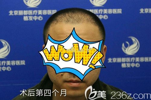 植發(fā)后四個月度過了脫落期 植發(fā)后四個月度過了脫落期