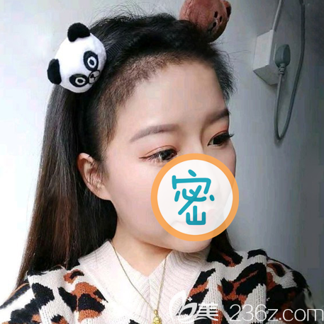 前額發(fā)際線種植一個月圖片 前額發(fā)際線種植一個月圖片