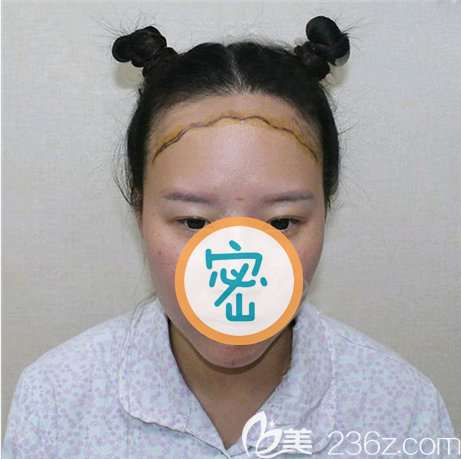 先天大額頭讓我的臉跟馬臉有一拼了 先天大額頭讓我的臉跟馬臉有一拼了