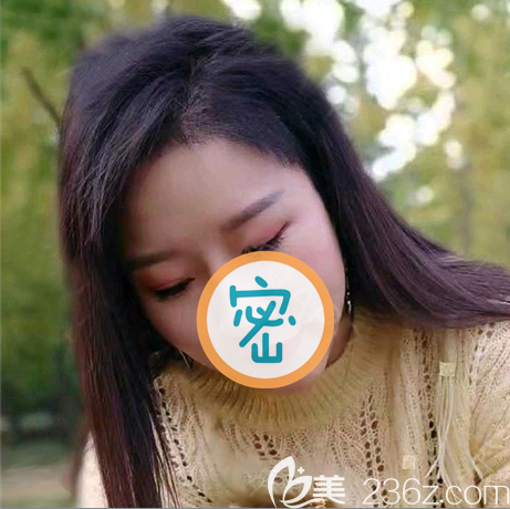 剛做完發(fā)際線種植后一星期頭發(fā)短比較難看，2個月后長長了就好多了