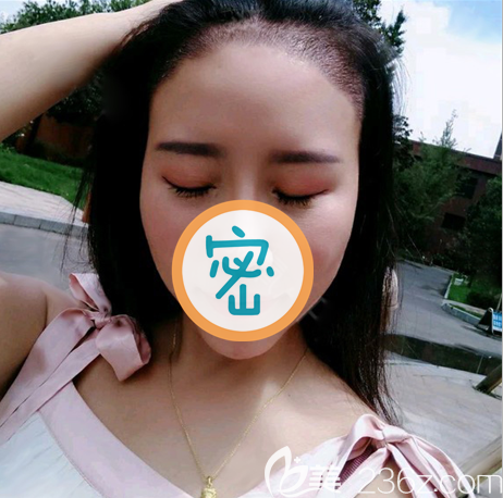 種植發(fā)際線一個禮拜 種植發(fā)際線一個禮拜